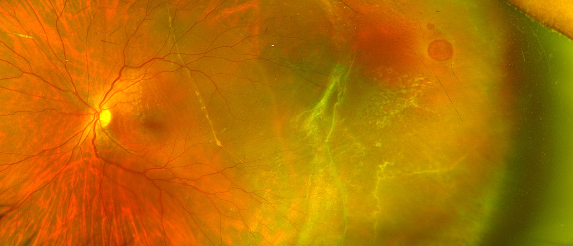 FEVR (Familial Exudative Vitreoretinopathy)