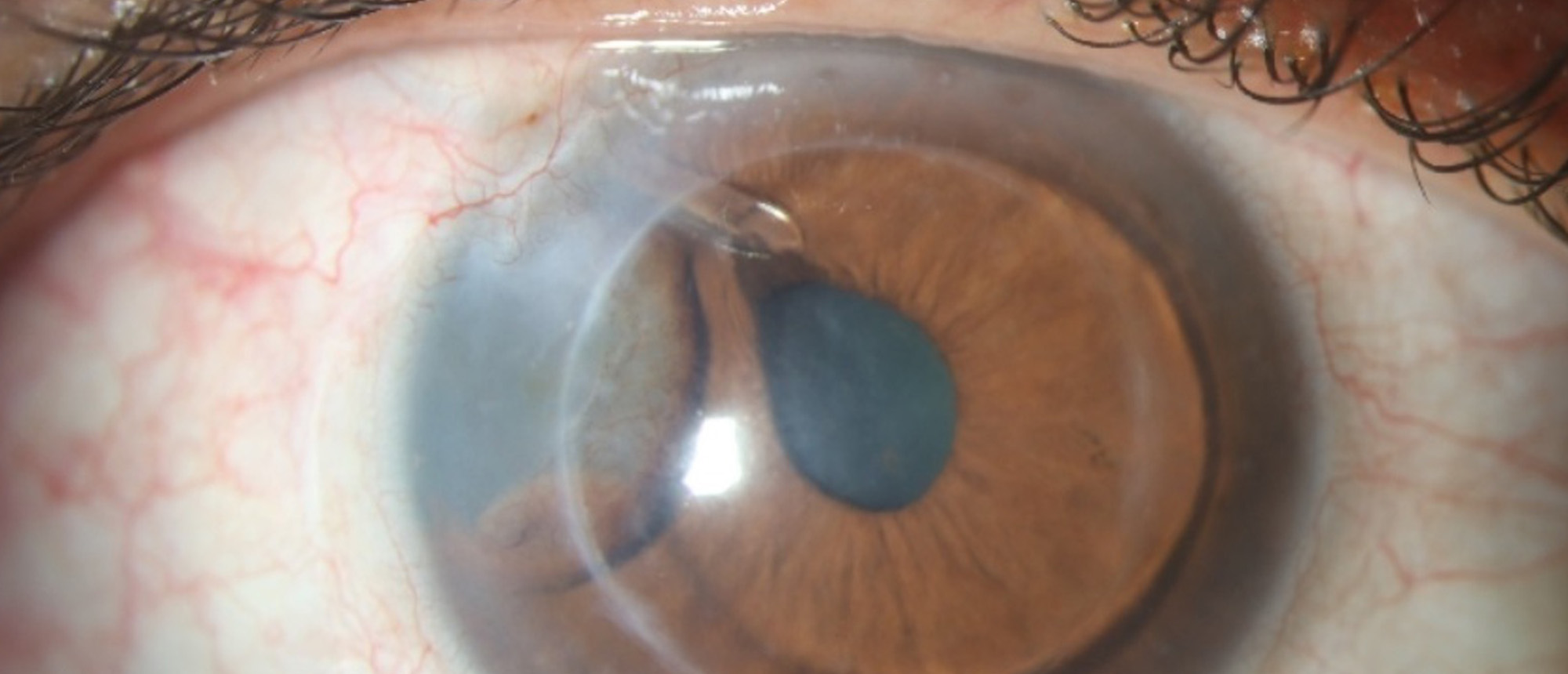 Epithelial Downgrowth