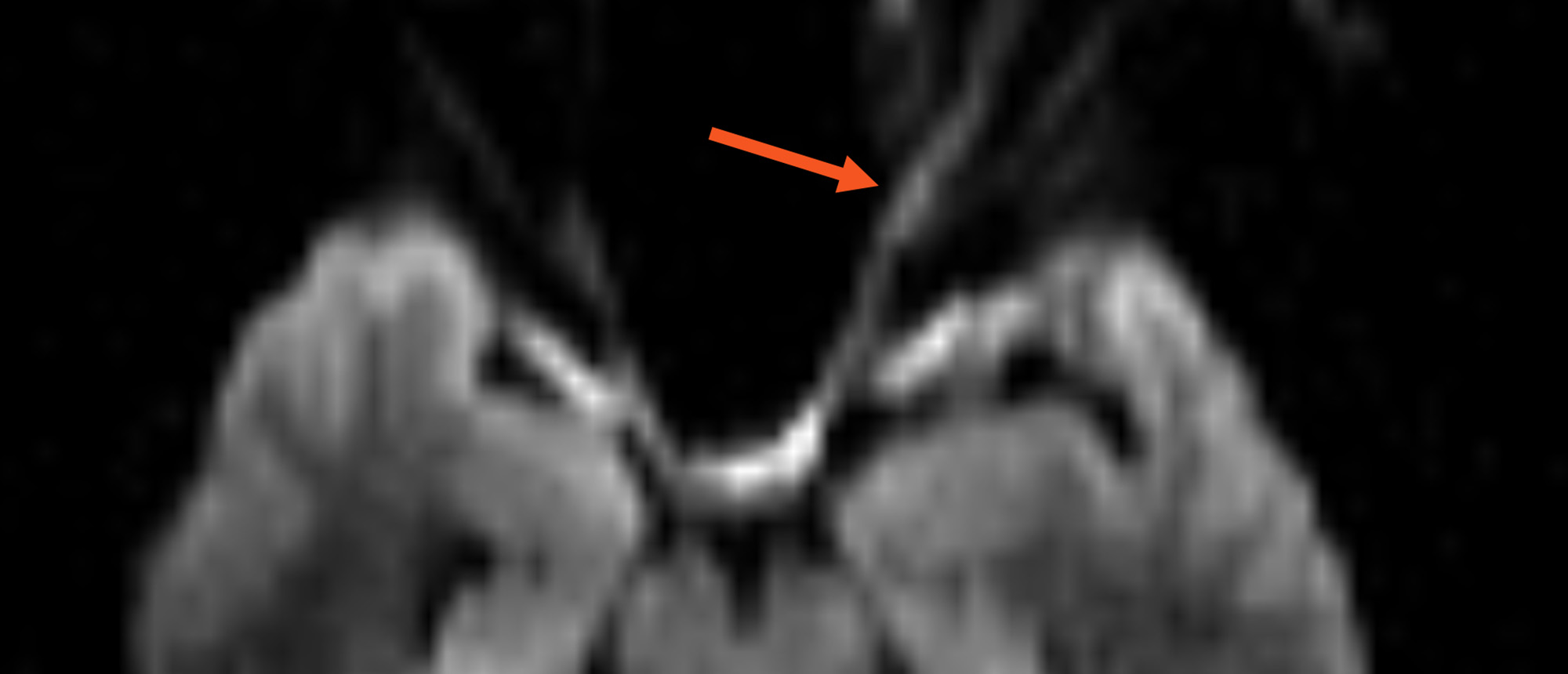 Traumatic Optic Neuropathy