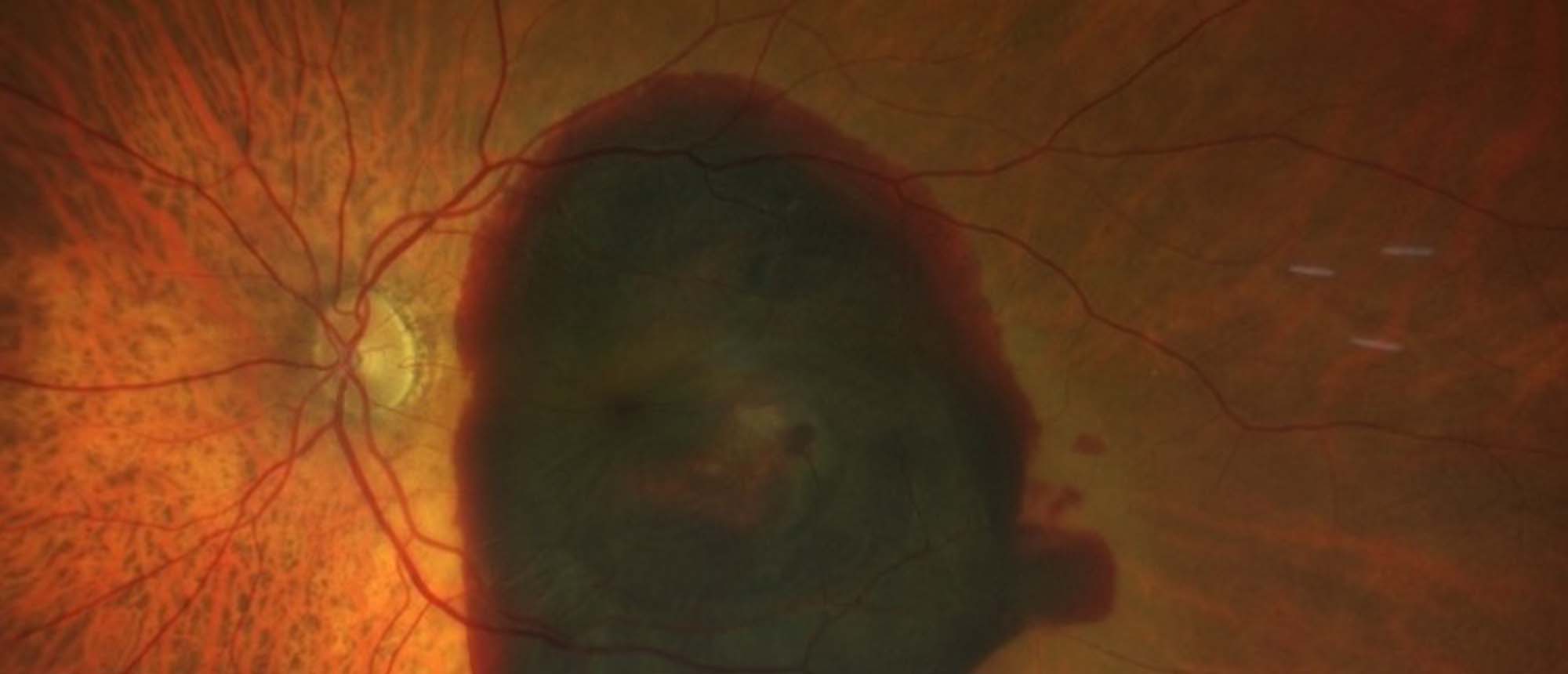 Submacular Hemorrhage Secondary to Age-Related Macular Degeneration