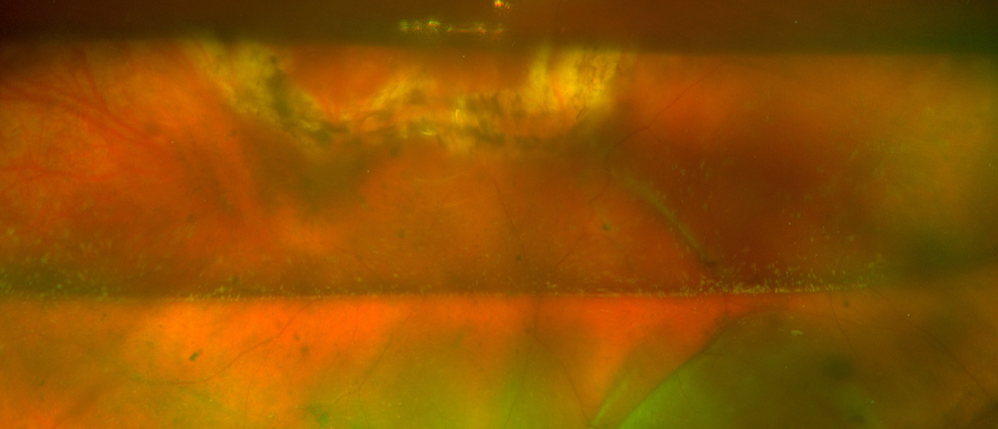Retinal Displacement After Retinal Detachment Repair