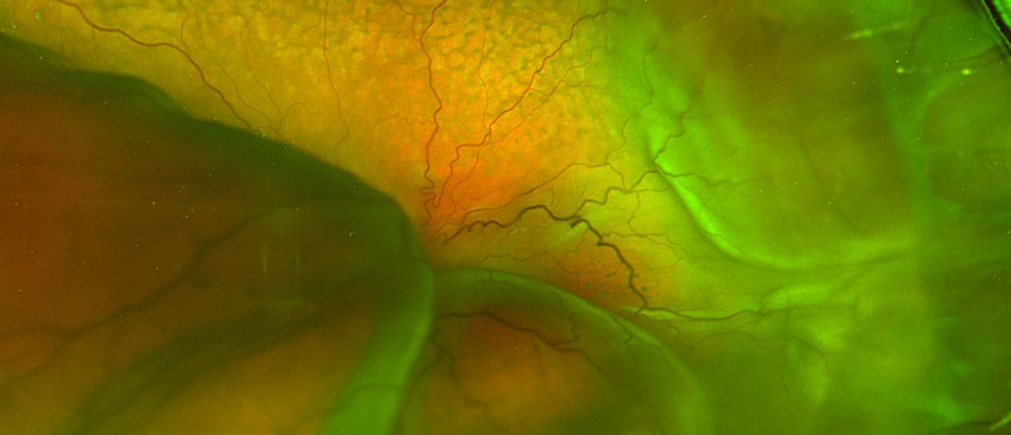 Uveal Effusion Syndrome