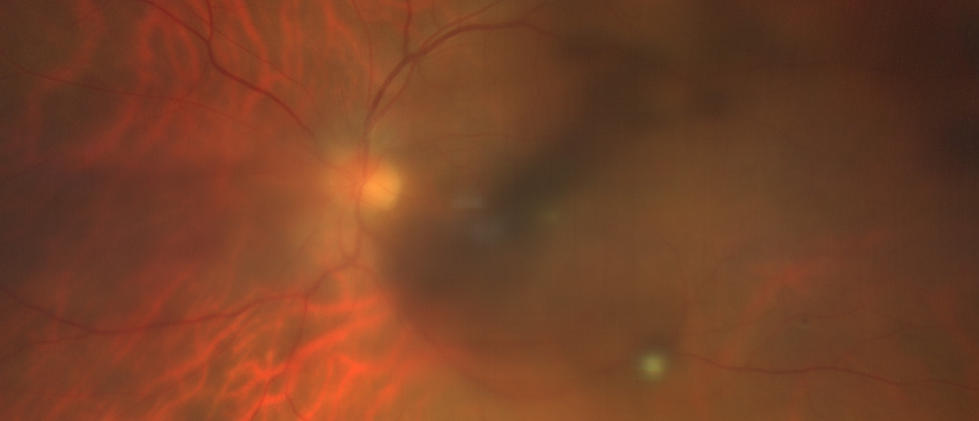 Endogenous Fungal Endophthalmitis