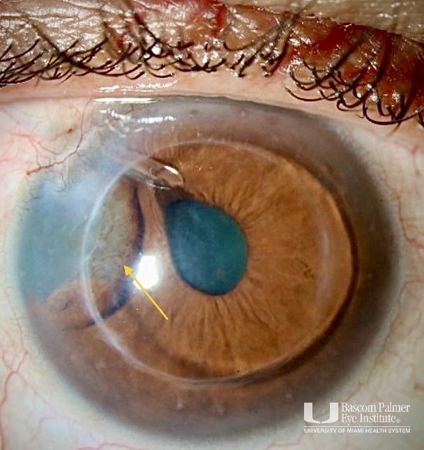 Iris Cyst