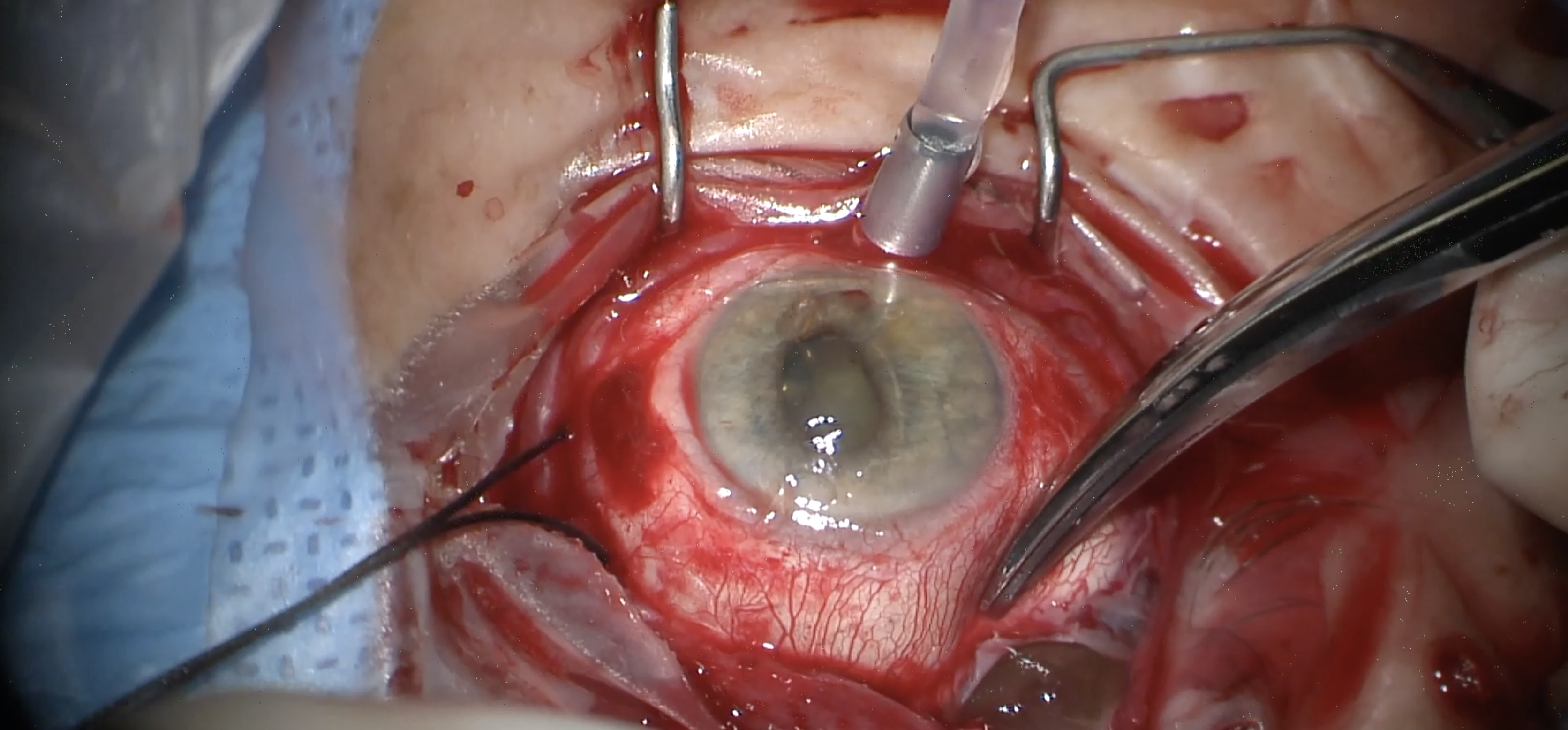 Removal with Vitrectomy for Hydrolyzed MIRAgel Implant