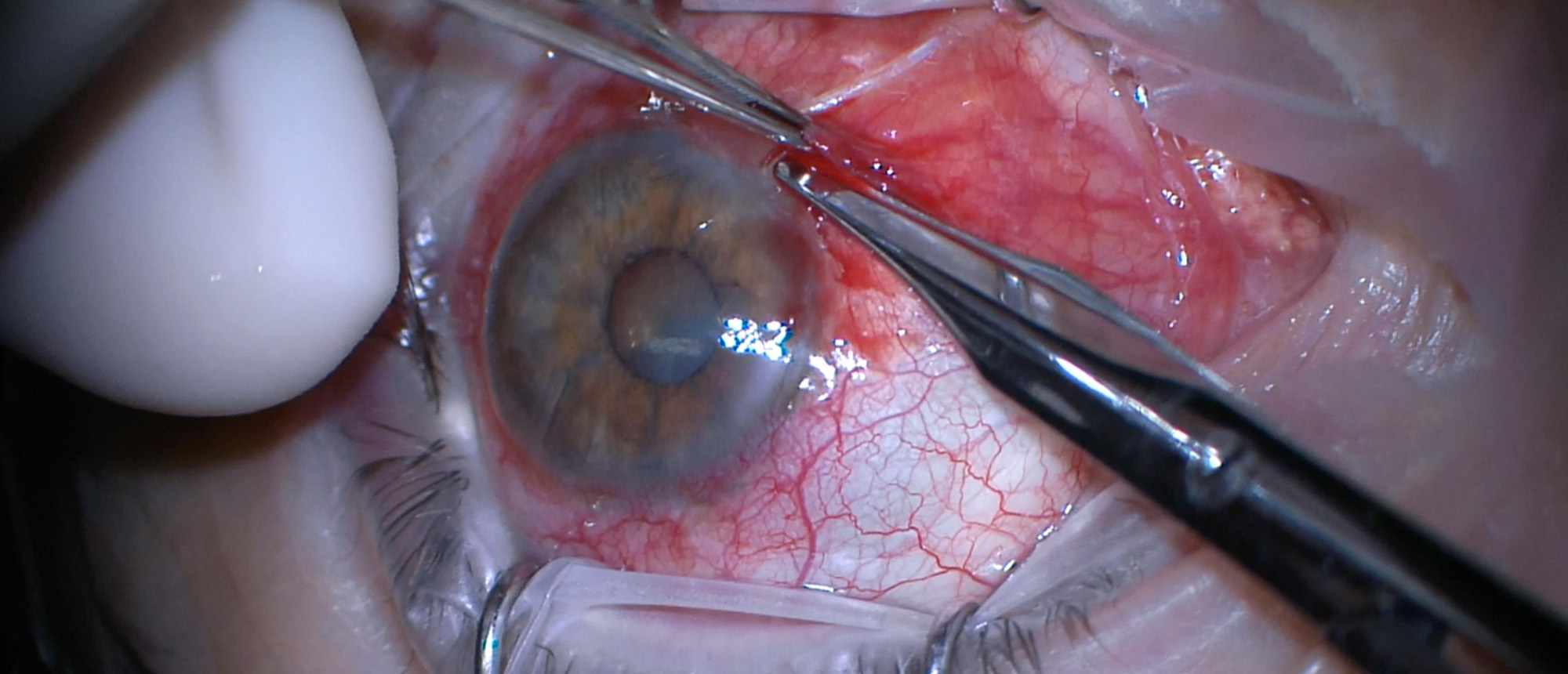 Motility Disturbances after Glaucoma Drainage Device