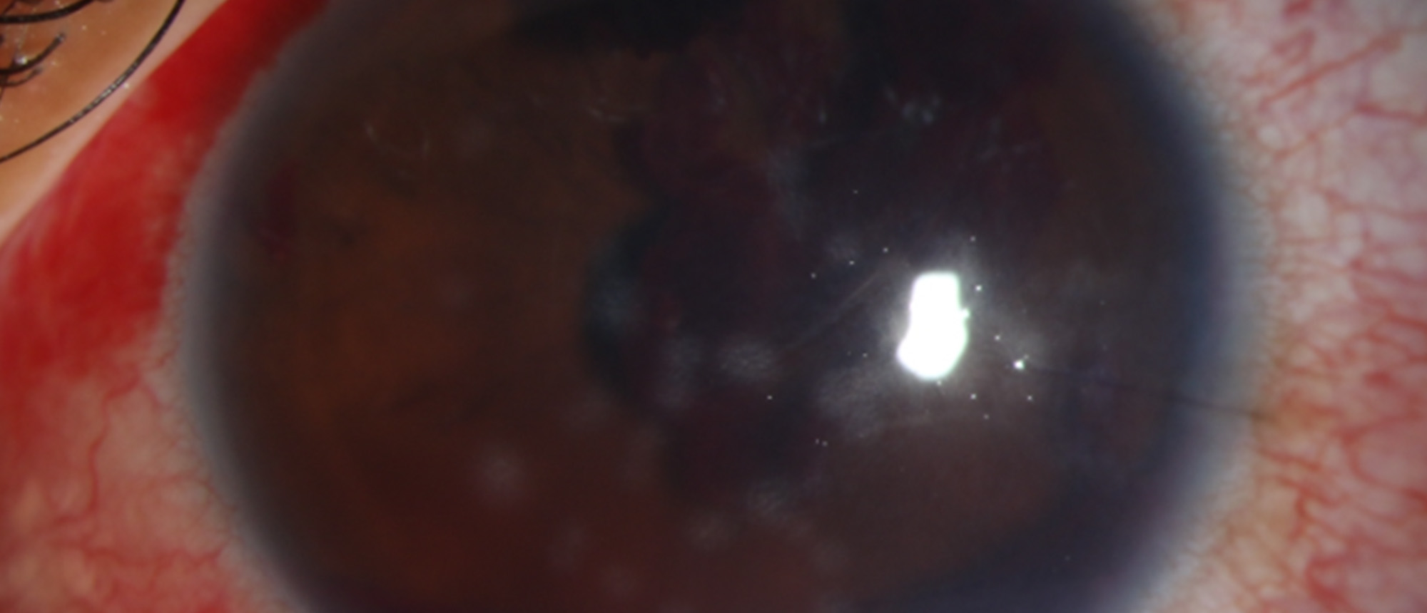 Chronic Angle-Closure Glaucoma