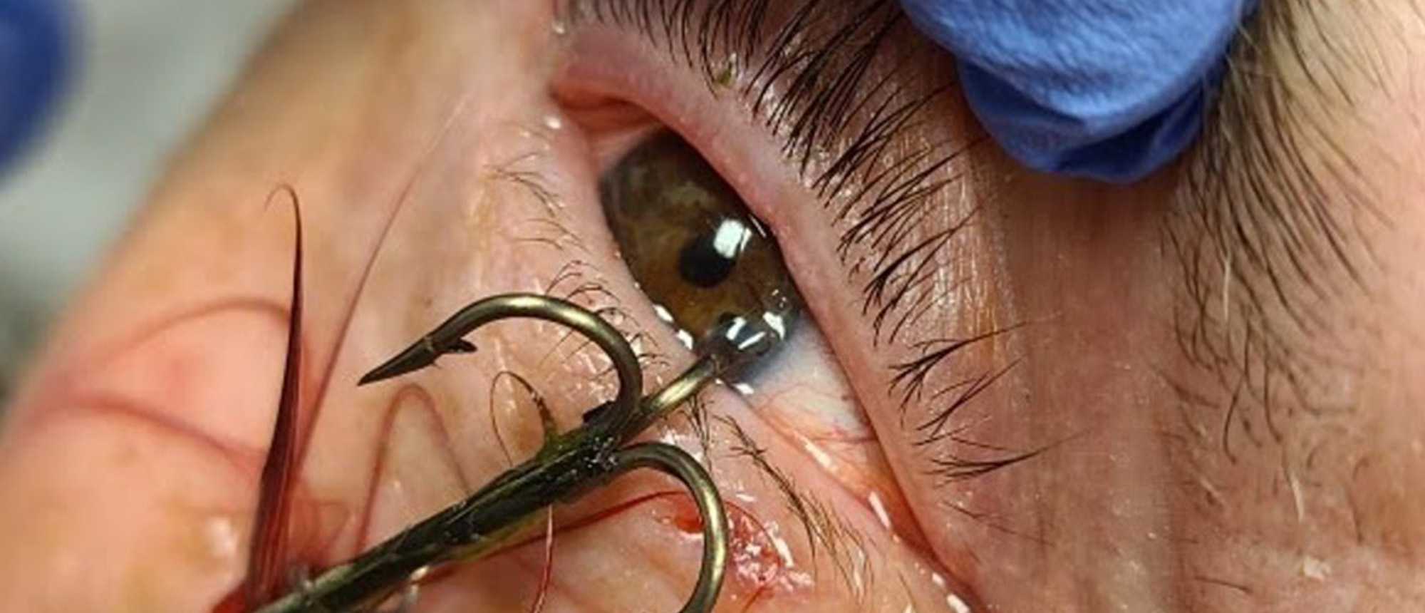 Penetrating Ocular Fishhook Injury
