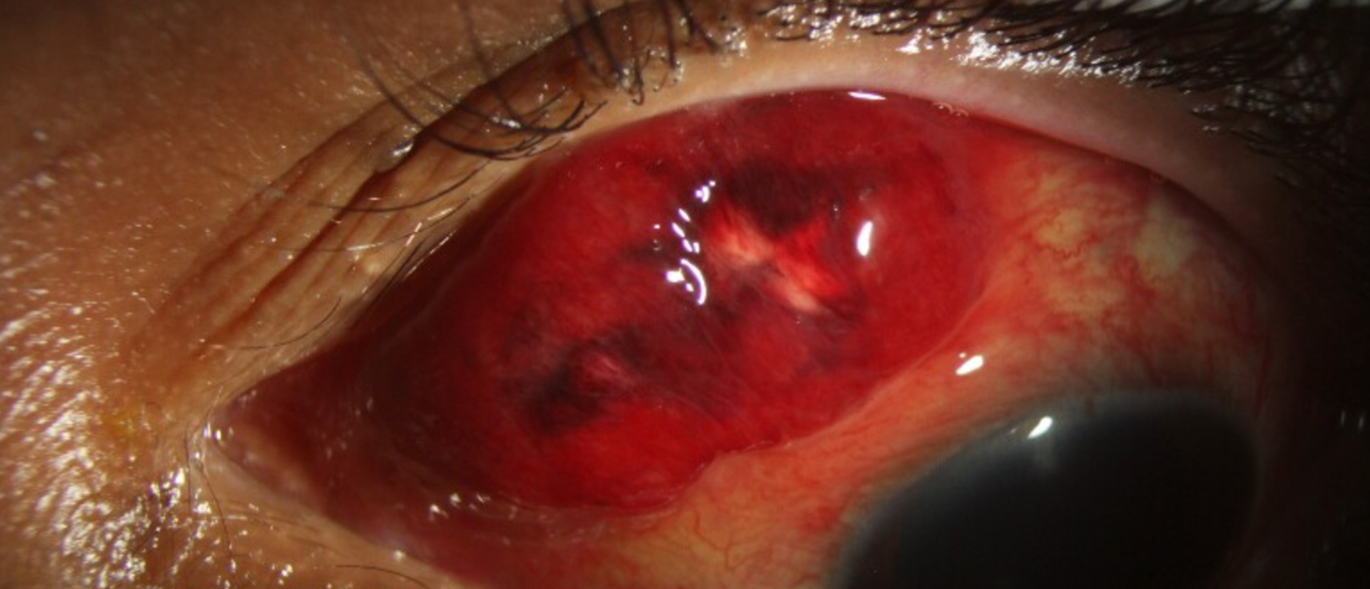 Kaposi's Sarcoma of the Conjunctiva