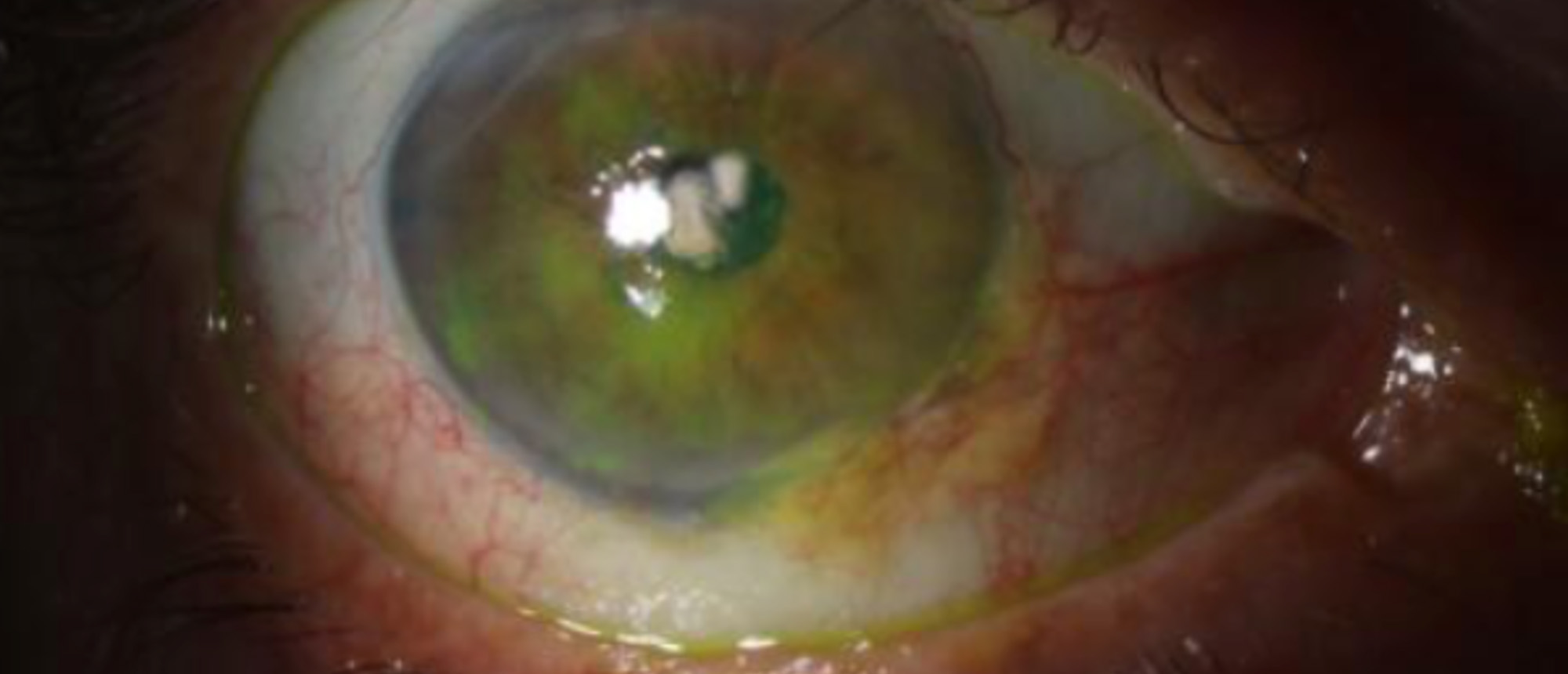 Ocular Surface Squamous Neoplasia
