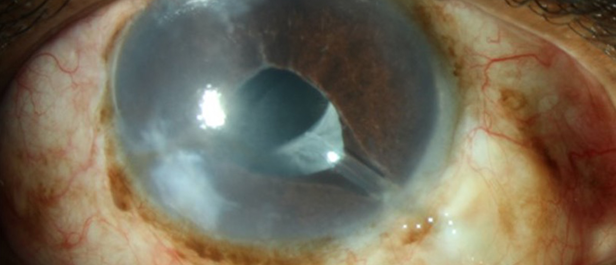Corneal Decompensation