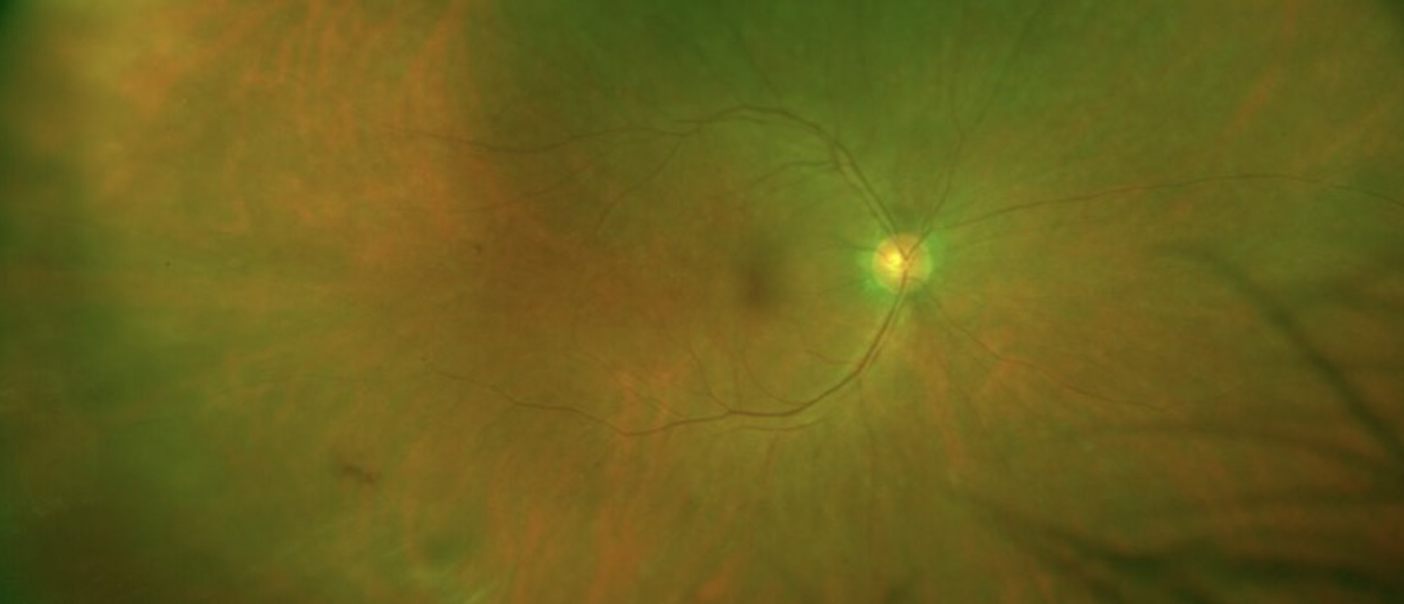 Paraneoplastic Autoimmune Retinopathy