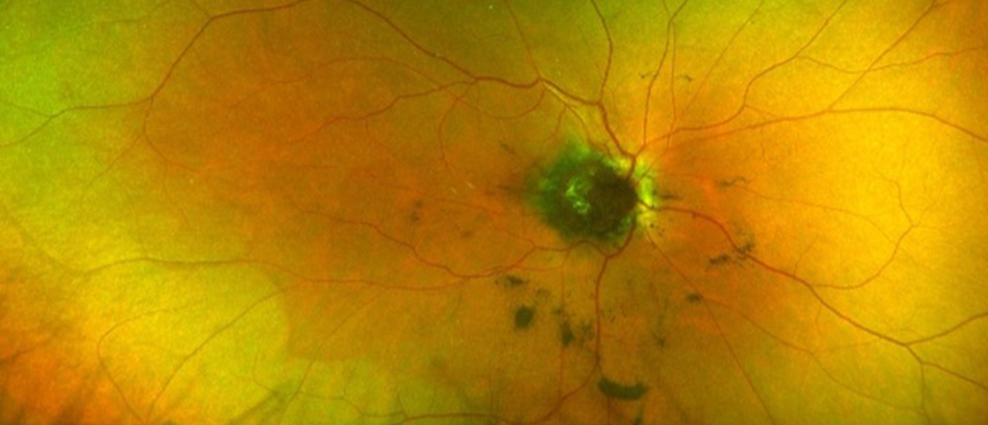 Melanocytoma with Vitreous Seeding