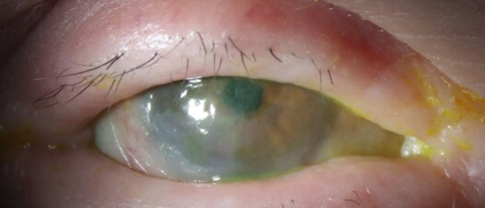 Ocular Cicatricial Pemphigoid