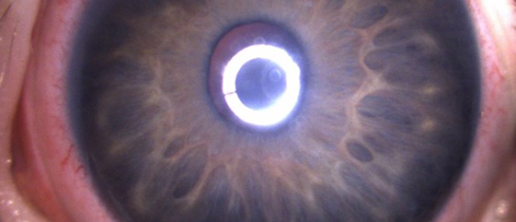 Primary Congenital Glaucoma