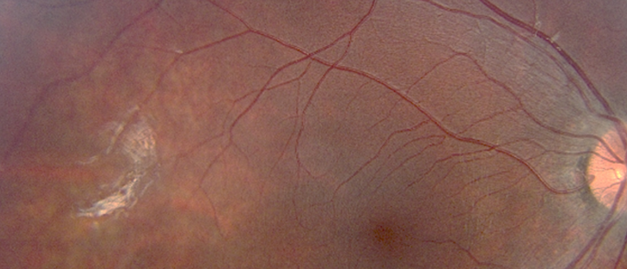 Microcephaly with or without Chorioretinopathy, Lymphedema or Intellectual Disability (MCLID)