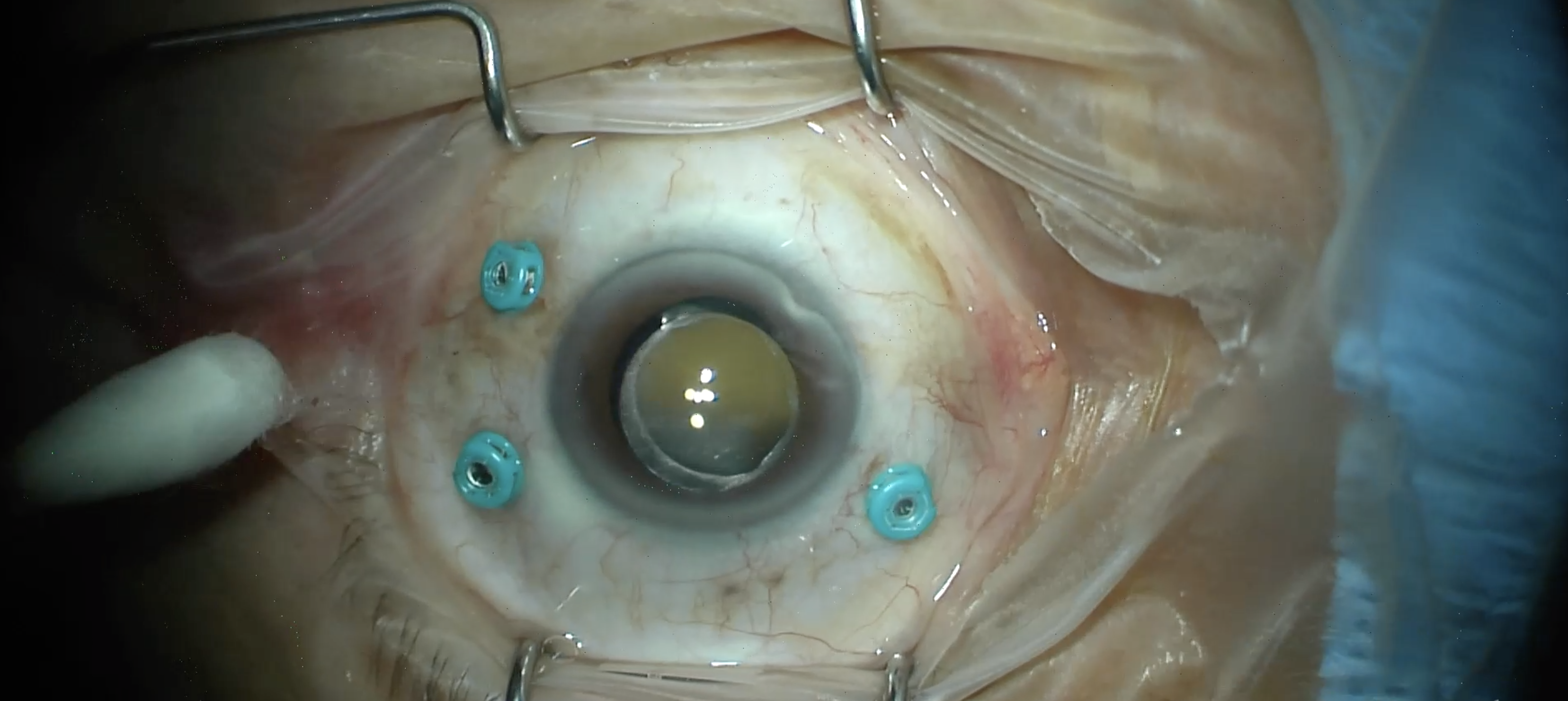 Submacular Hemorrhage PPV+tPA+SF6