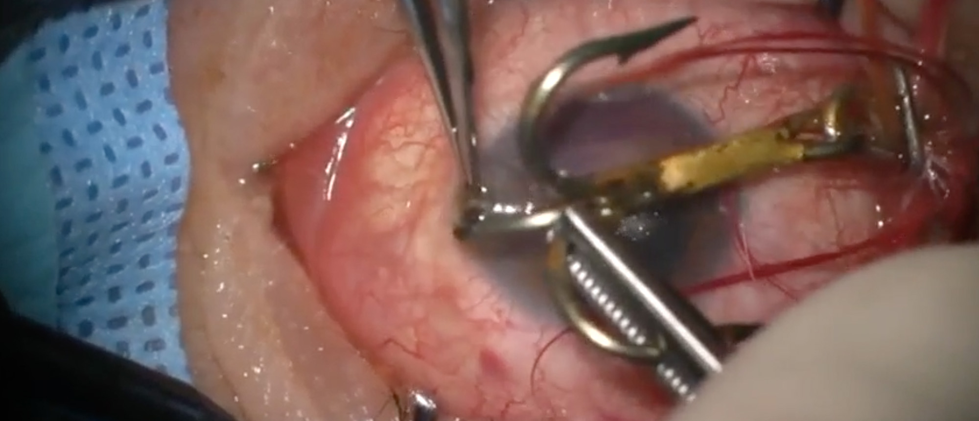 Penetrating Ocular Fishhook Injury