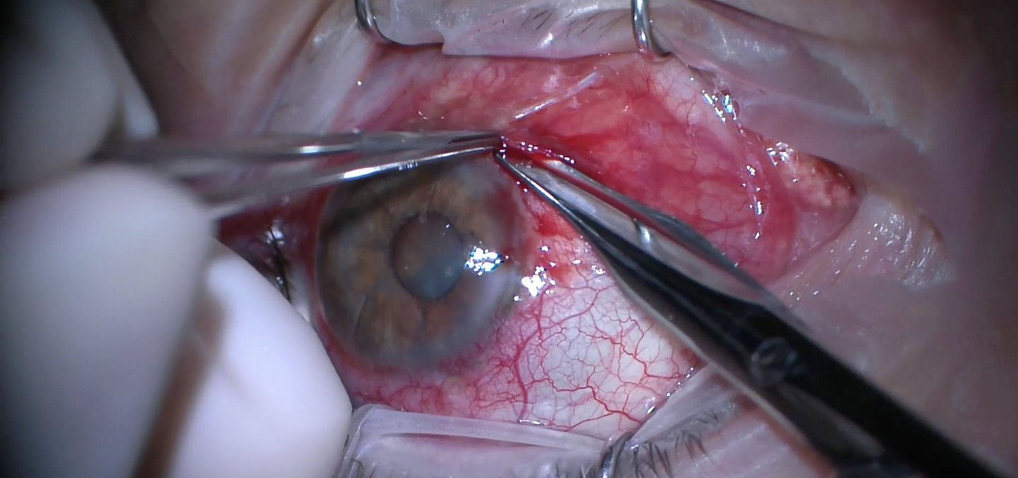 Explant of Baerveldt GDD