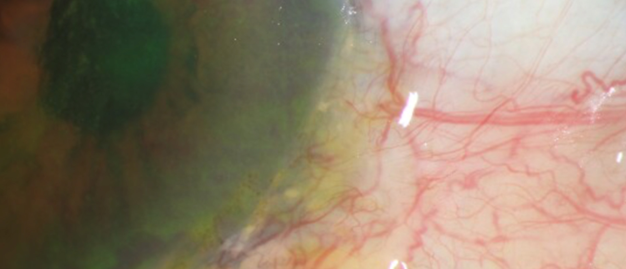 OSSN Masquerading as a Pinguecula/Severe Dry Eye