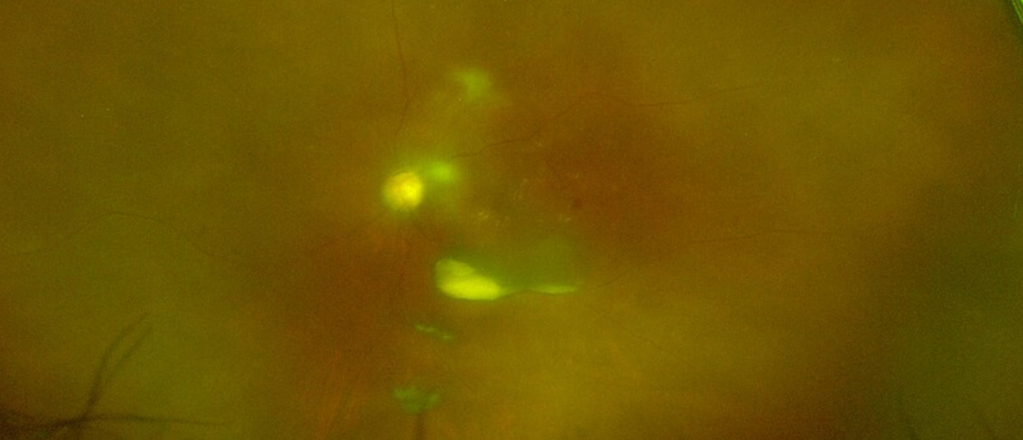 Ghost Cell Glaucoma