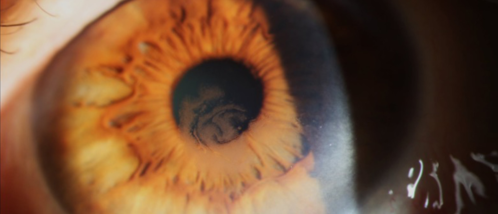 Lisch Corneal Dystrophy