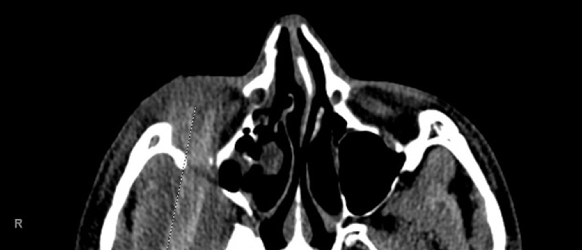 Intraorbital Foreign Body