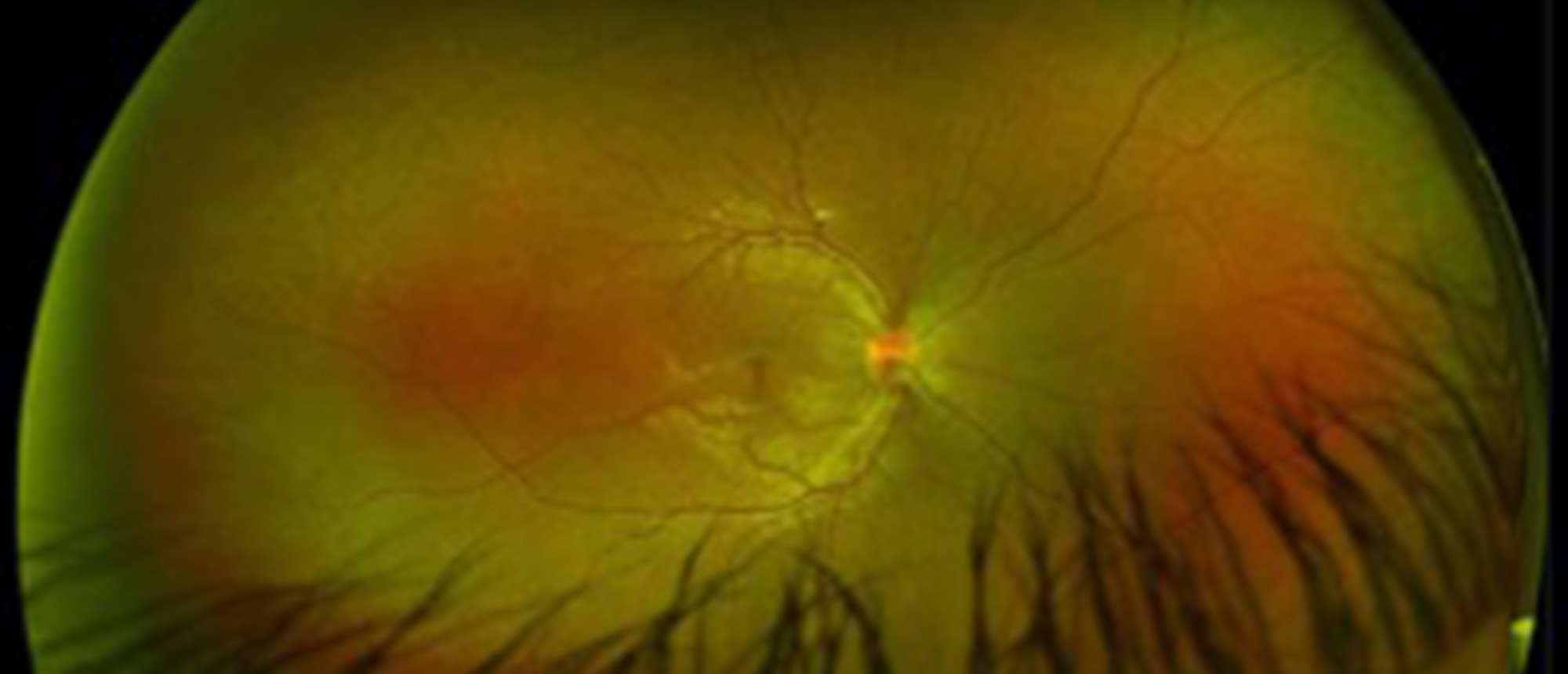 Idiopathic Intracranial Hypertension with Secondary Choroidal Neovascular Membrane