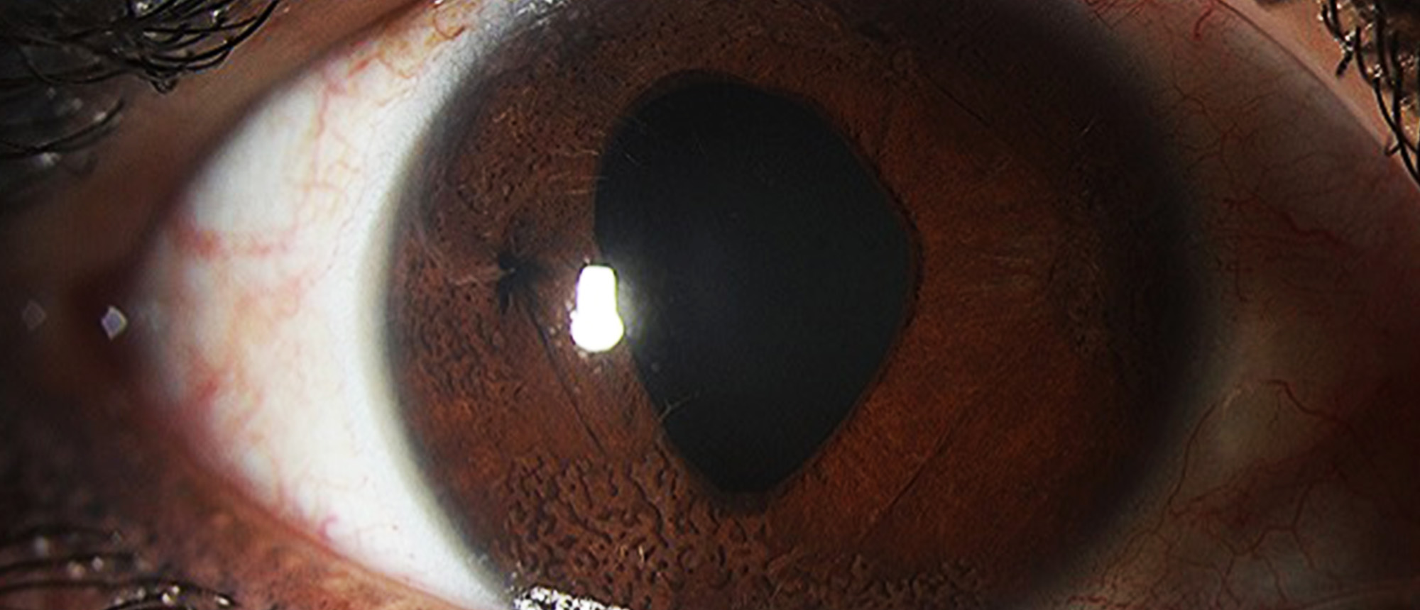 Iridocorneal Endothelial Syndrome, Cogan-Reese/Iris Nevus Syndrome Subtype with Secondary Angle Closure Glaucoma
