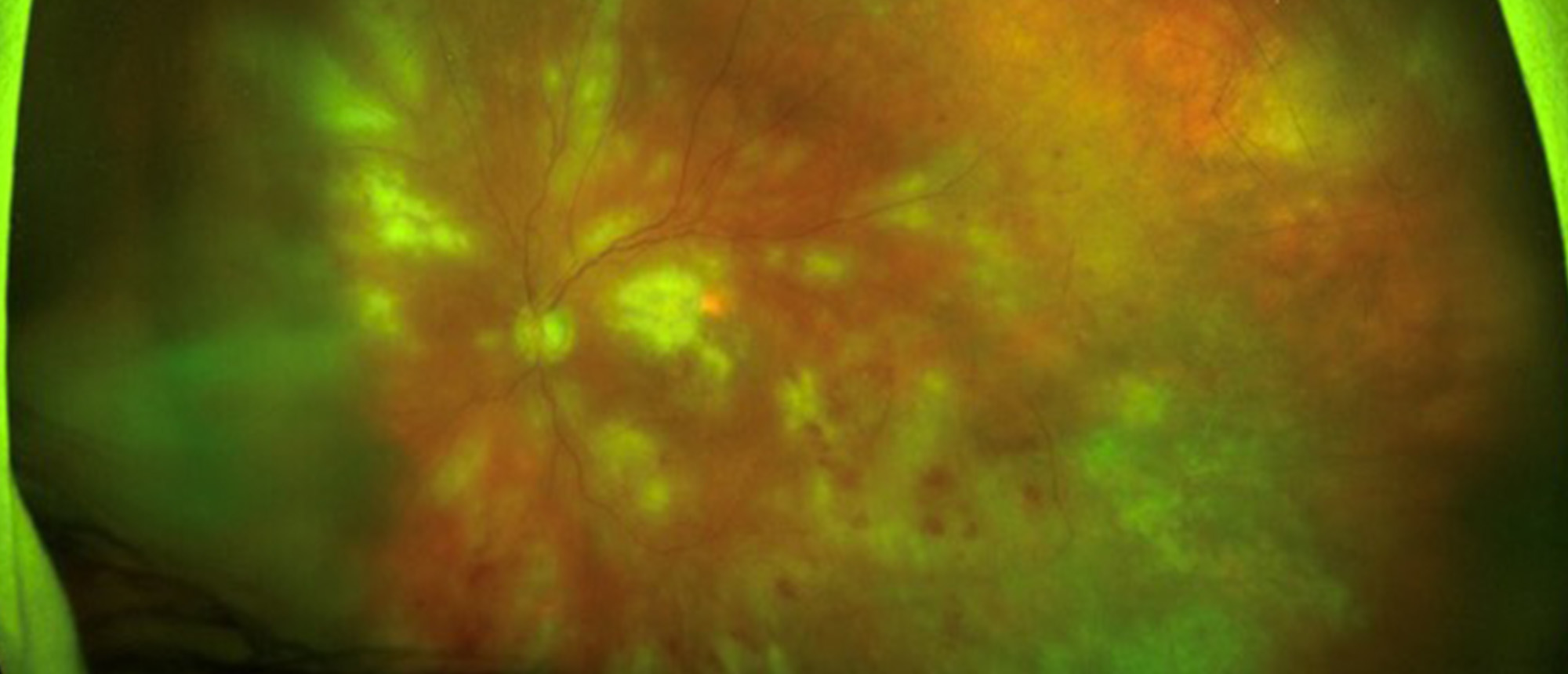 CMV Retinitis