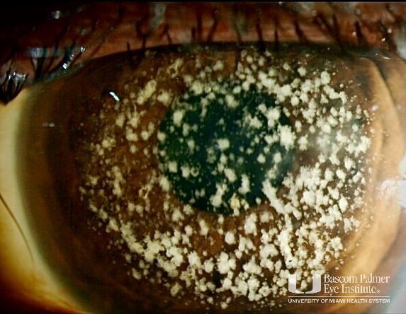 Case of granular dystrophy treated with penetrating keratoplasty 