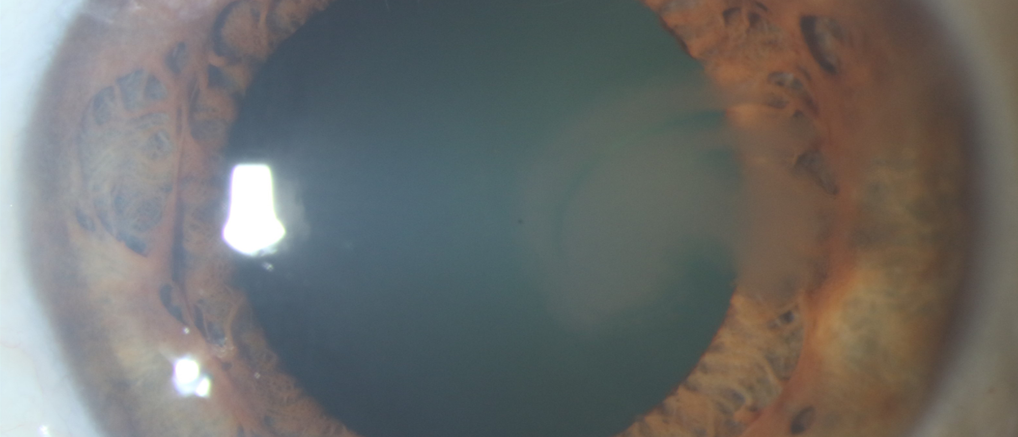 Lisch Corneal Dystrophy