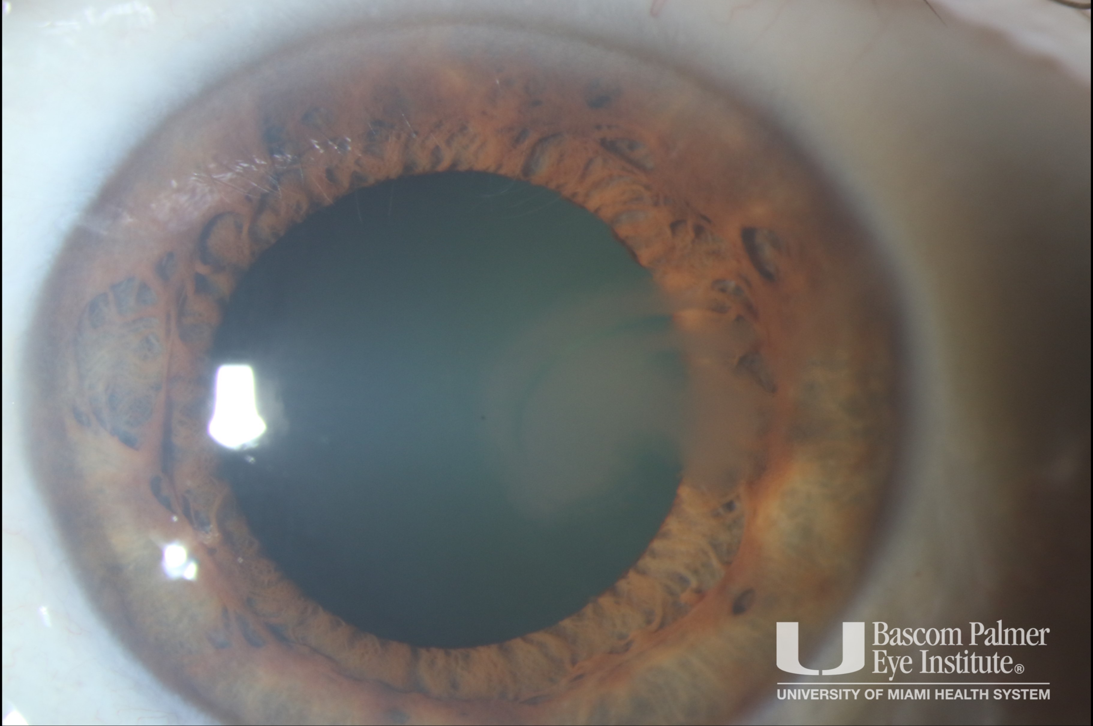 Slit lamp photo of biopsy proven Lisch Corneal dystrophy.