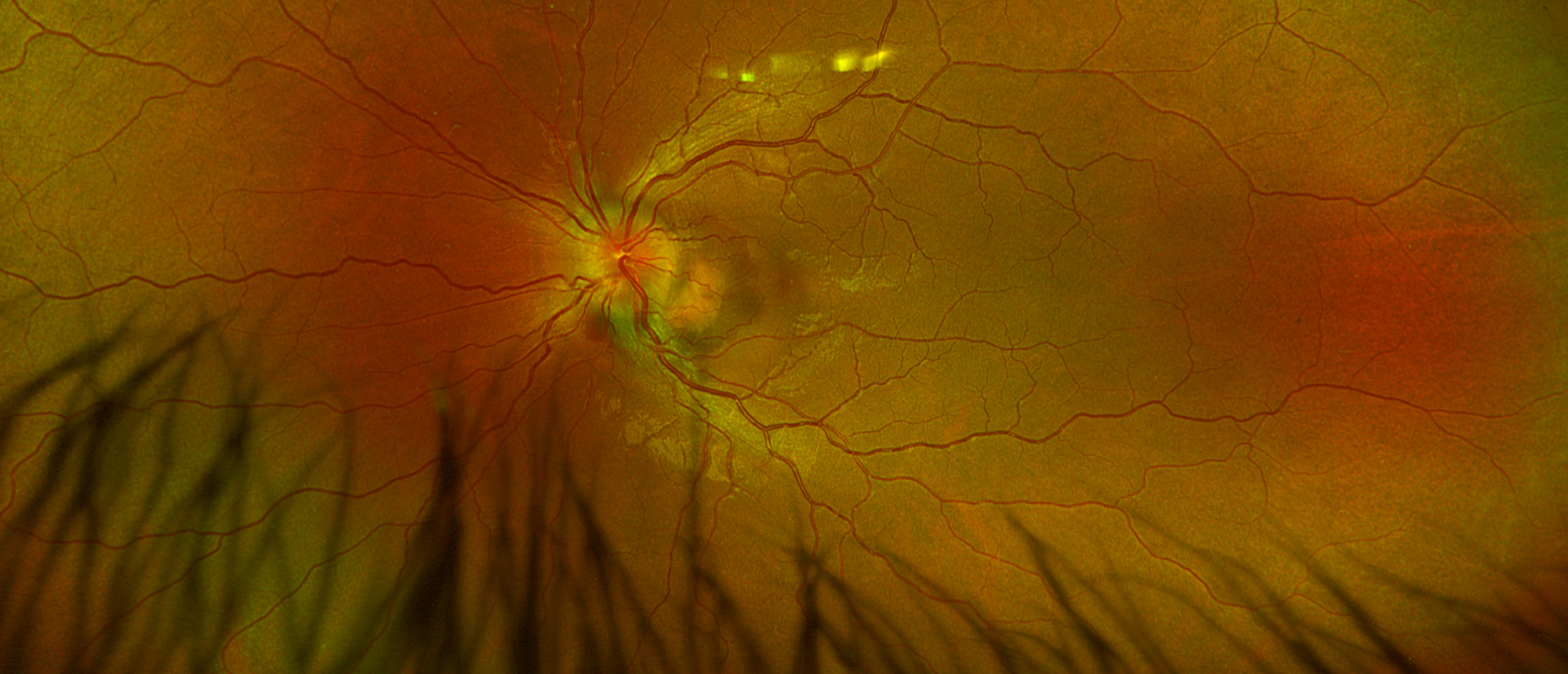 Idiopathic Intracranial Hypertension Complicated by Peripapillary Choroidal Neovascular Membrane Formation