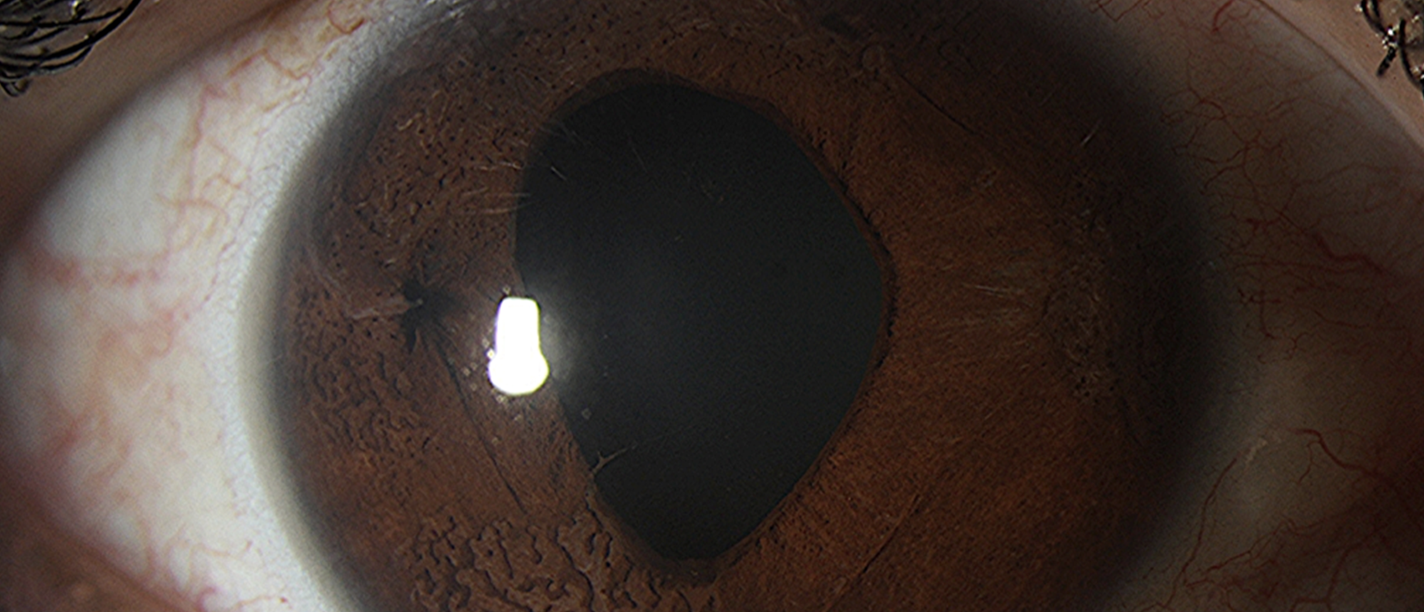 Iridocorneal Endothelial (ICE) Syndrome, Cogan-Reese/Iris Nevus Syndrome Subtype