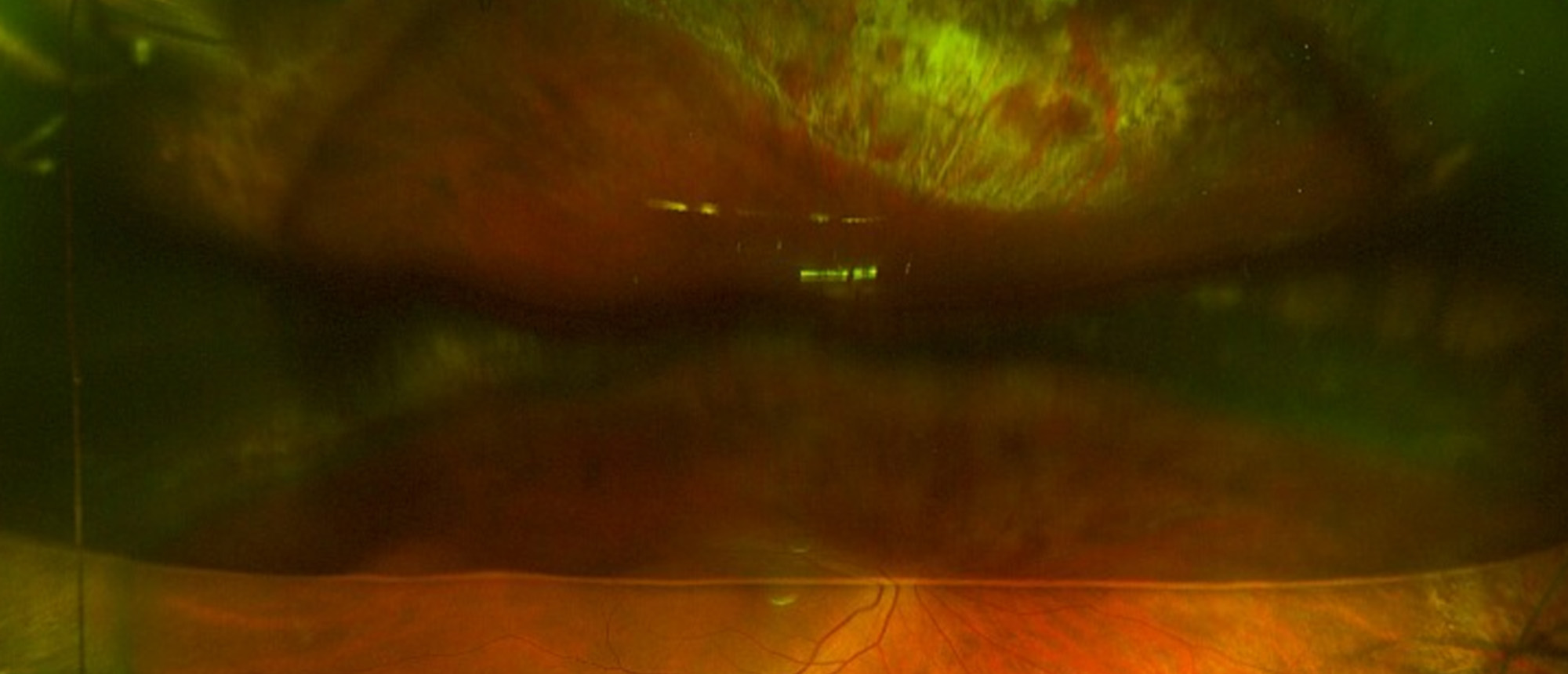 Retinal Tear in a Fellow Eye