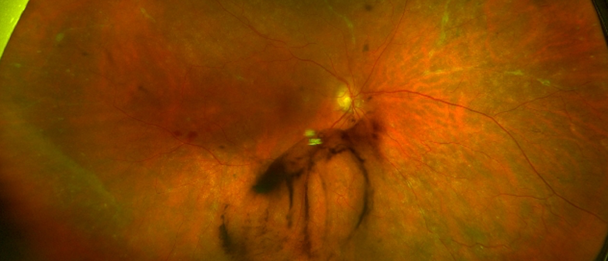 Hereditary Transthyretin Amyloidosis (hATTR)