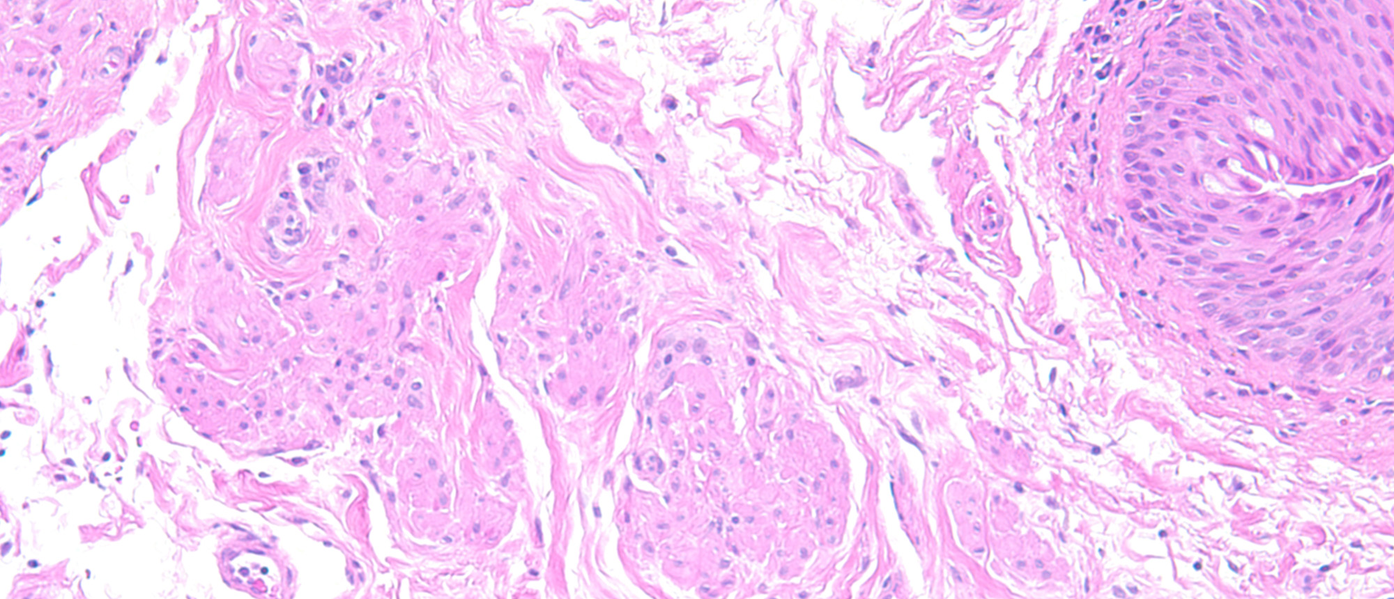 Smooth Muscle Hamartoma