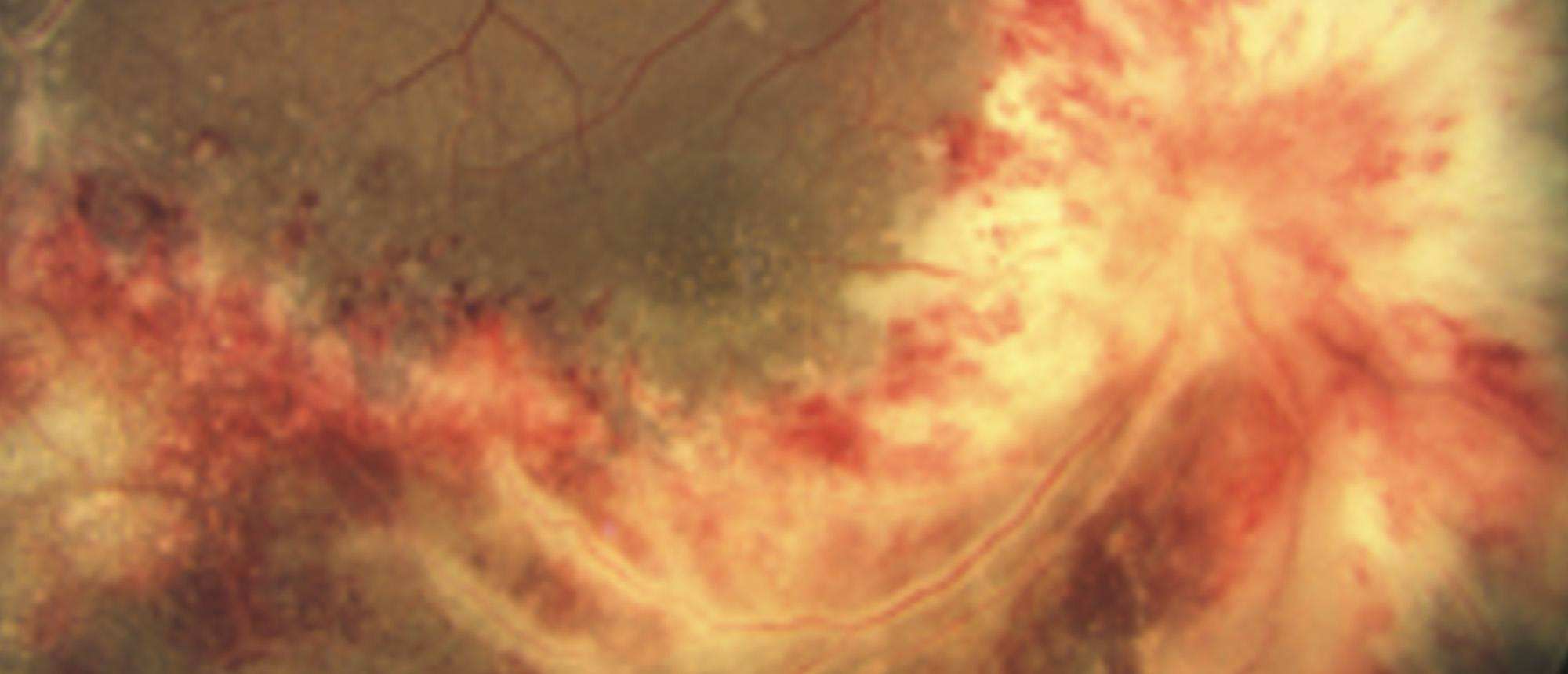 Cytomegalovirus Anterior Uveitis