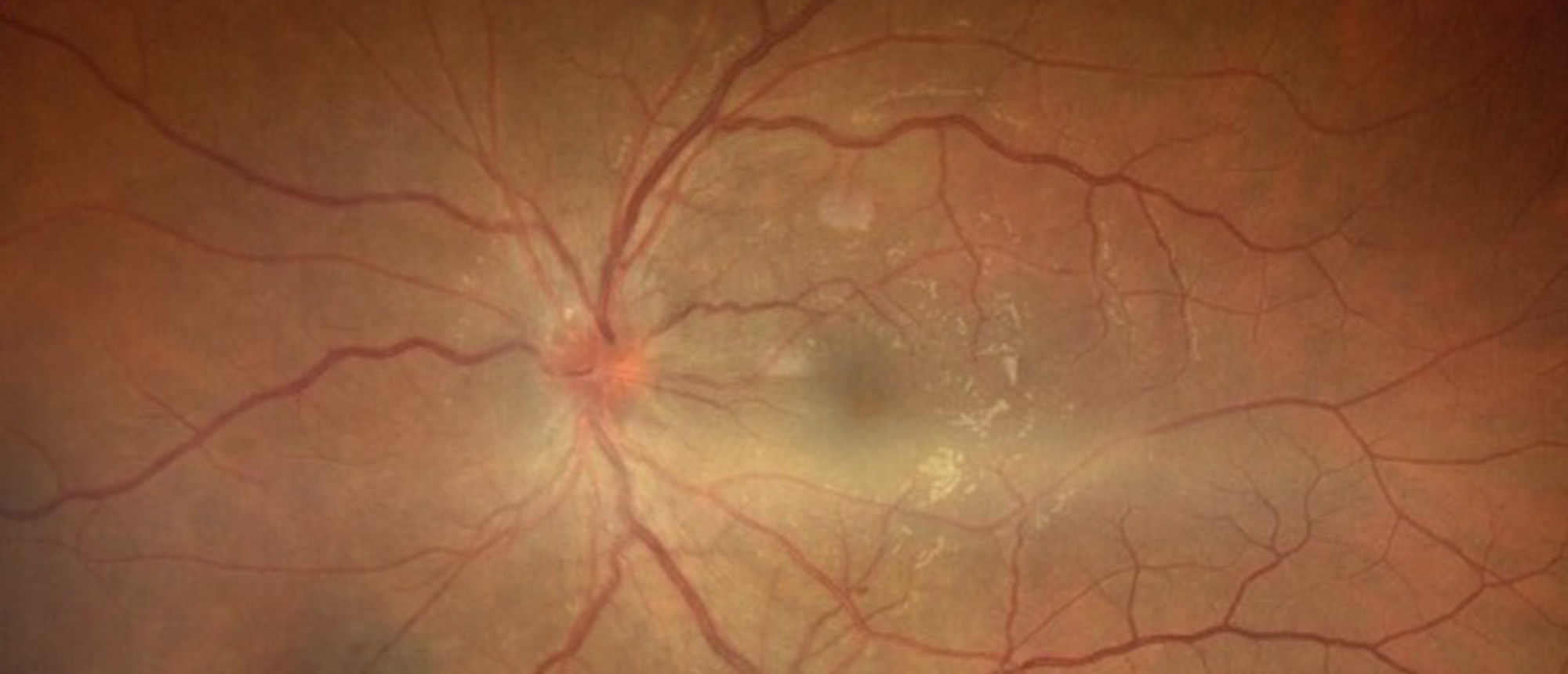 Acute Syphilitic Posterior Placoid Uveitis