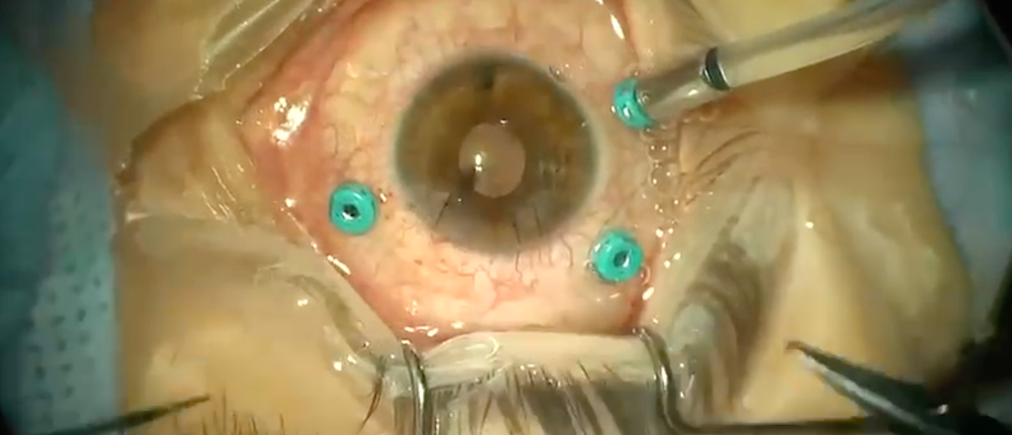 Epiretinal Membrane Peel Post IOFB