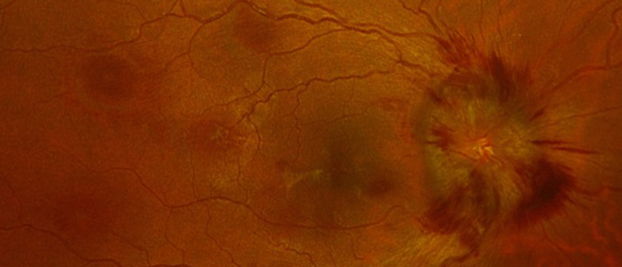 Vitamin A Induced Intracranial Hypertension