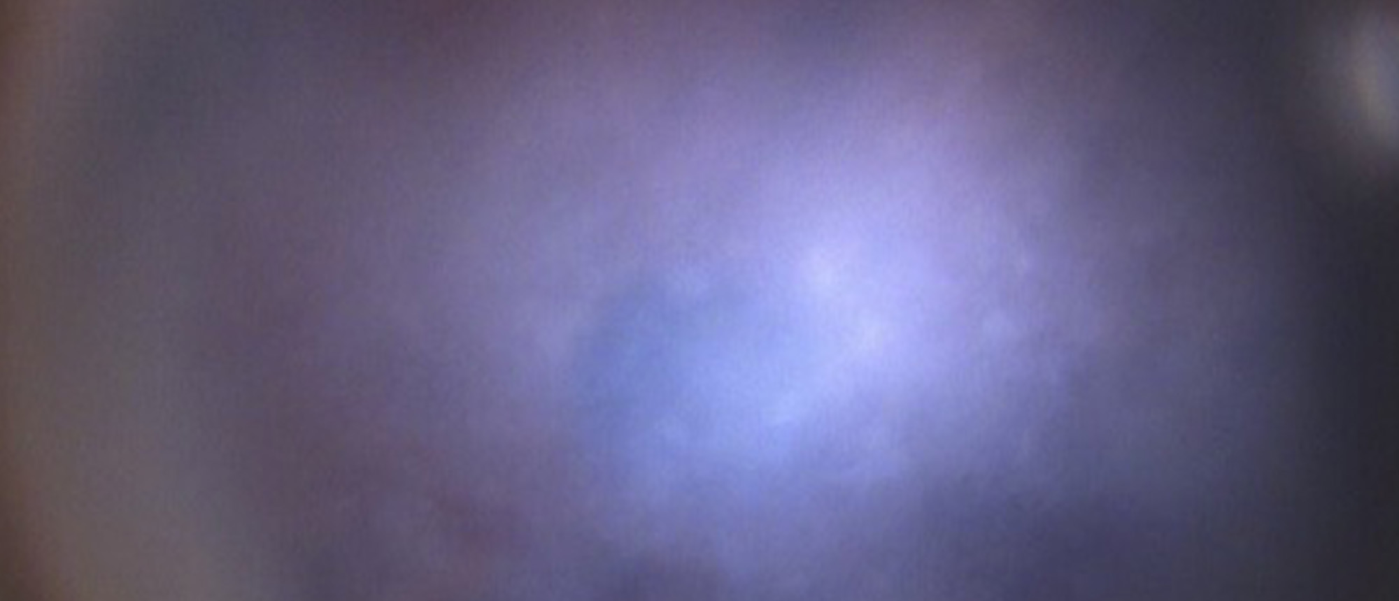 Congenital Hereditary Endothelial Dystrophy