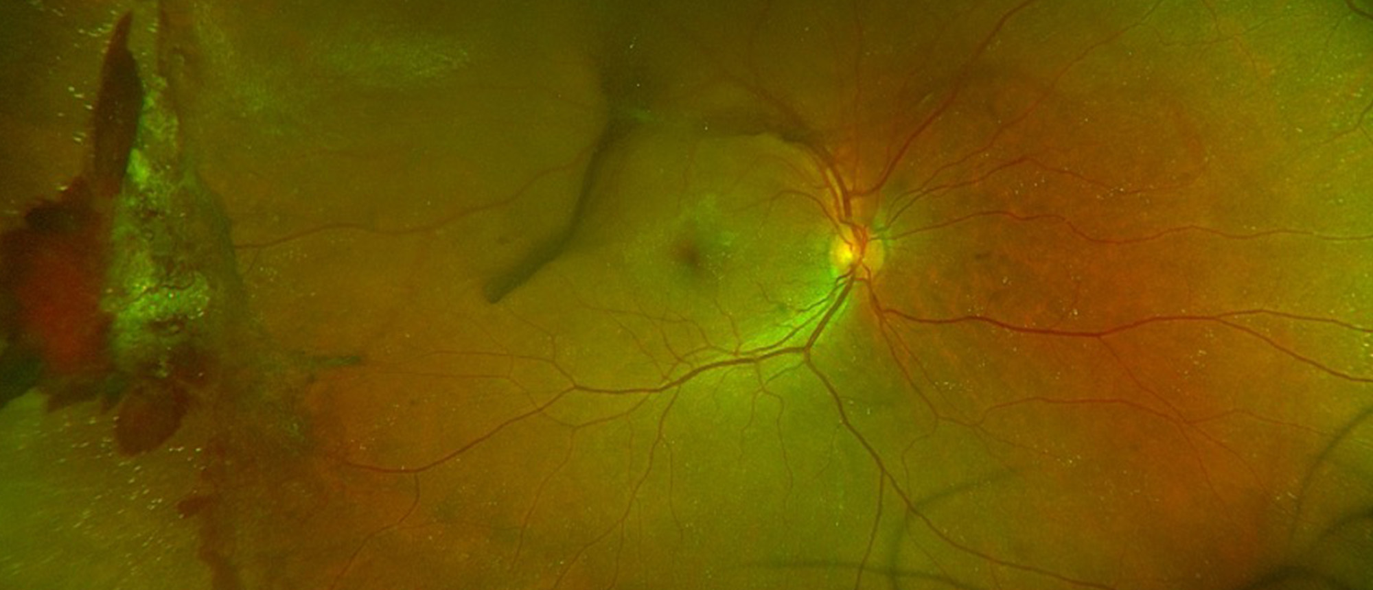 Retinal Arteriole Occlusions Secondary to Silicone Microembolization