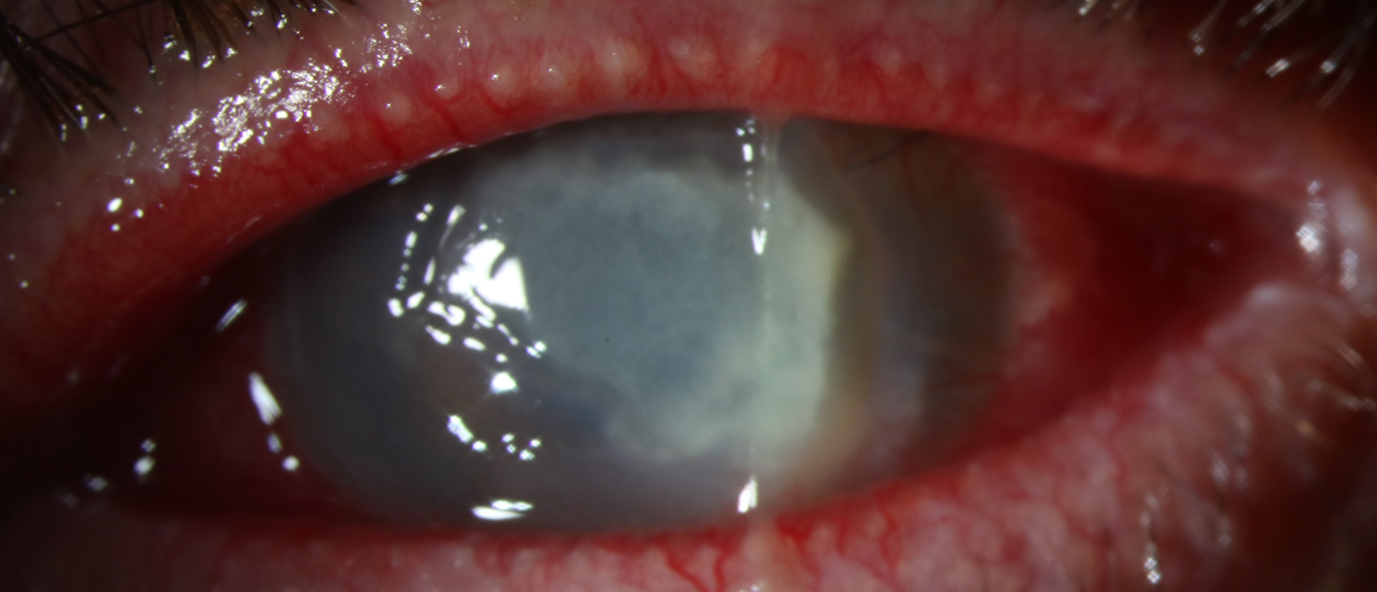 Alternaria Keratitis