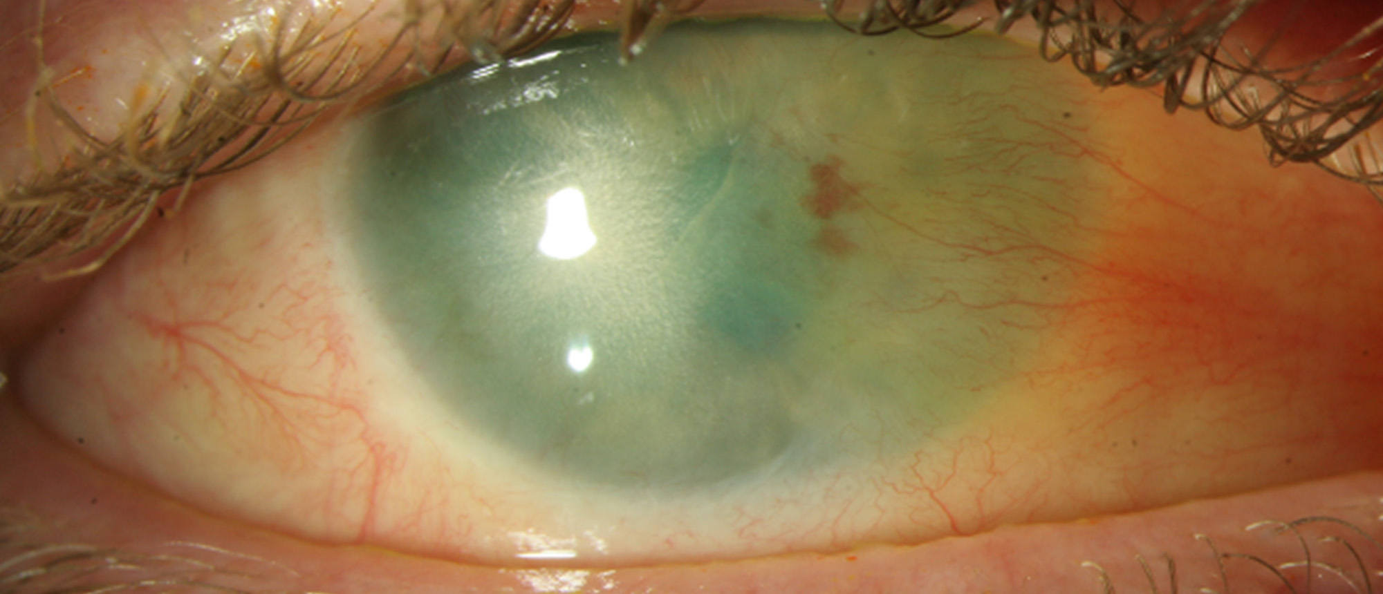 Bilateral Limbal Stem Cell Deficiency