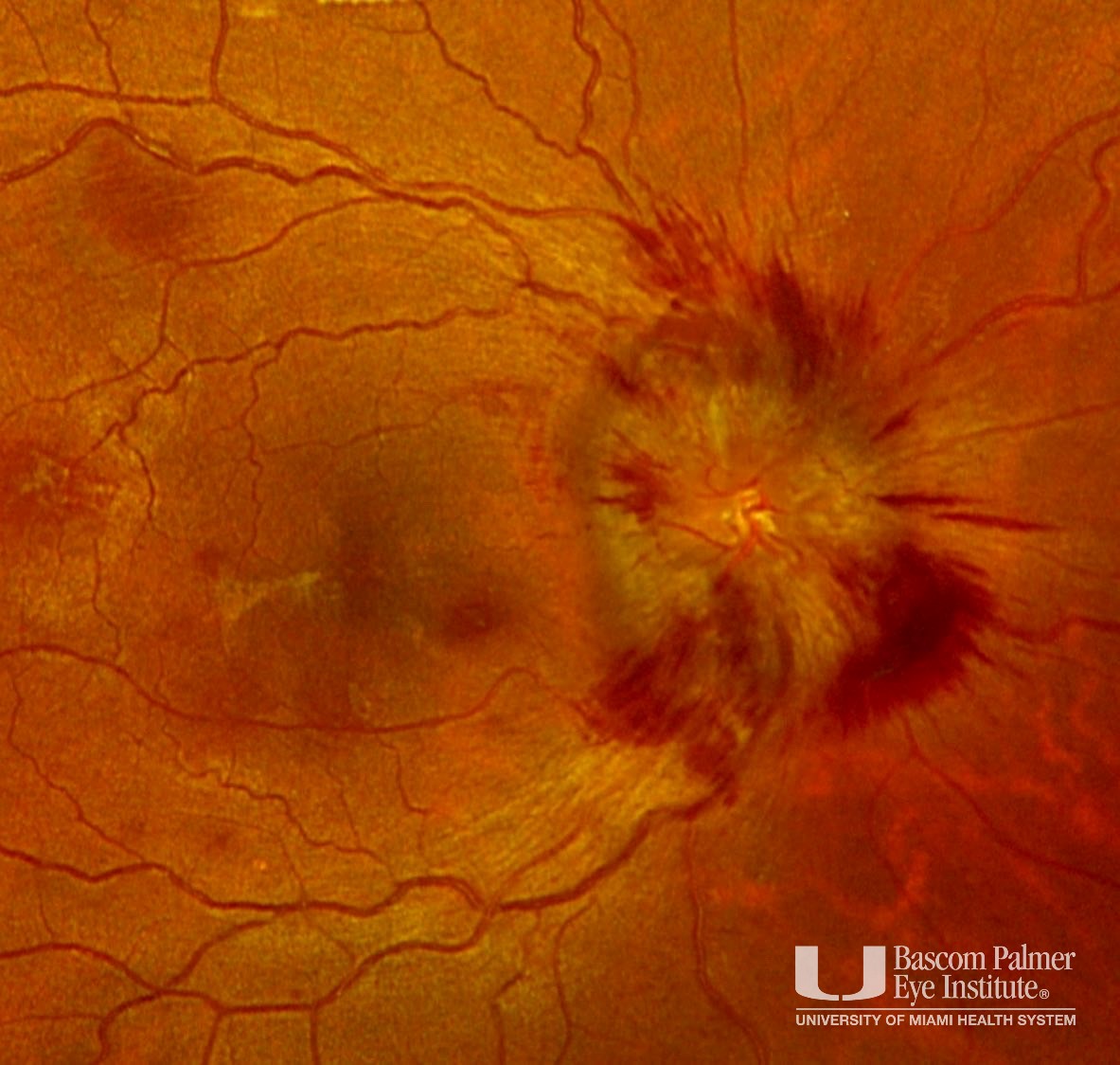 Papilledema from Hypervitaminosis A