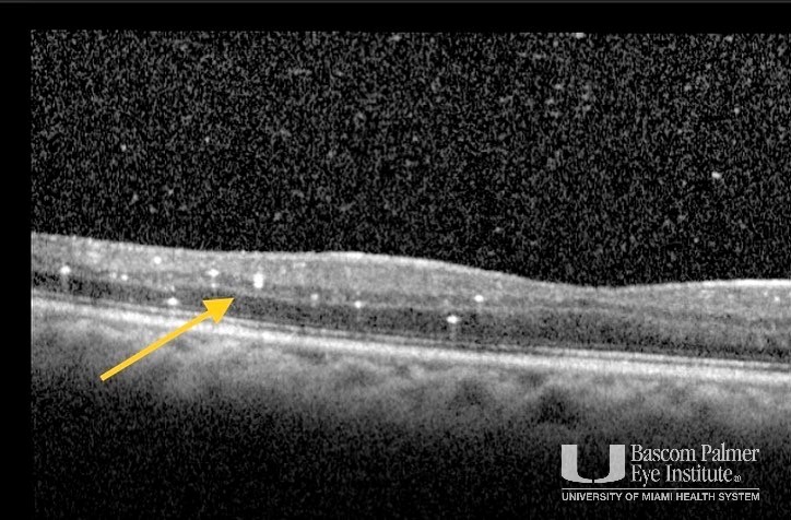 Silicone gluteal injections leading to retinal arterial embolization 