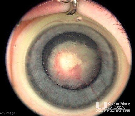 Persistent Fetal Vasculature