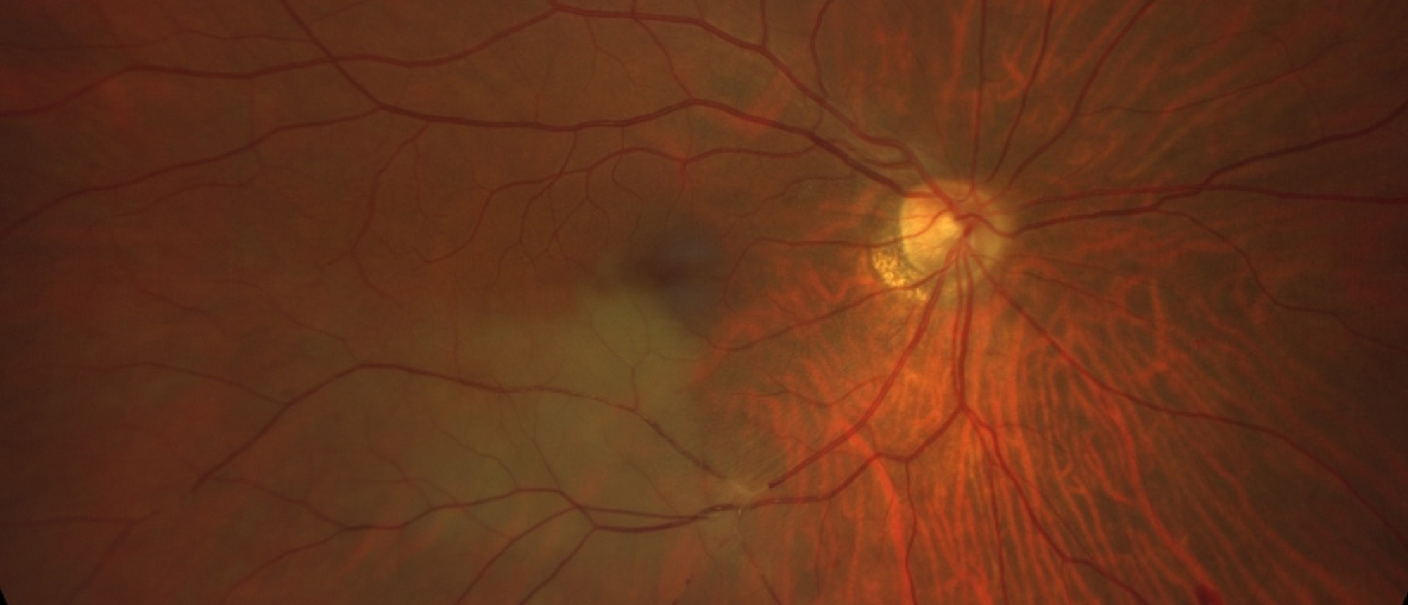 Branch Retinal Artery Occlusion